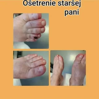 Ošetrenie nôh staršej klientky — pred a po